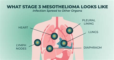 Understanding Mesothelioma Stages And Treatment A Comprehensive Guide