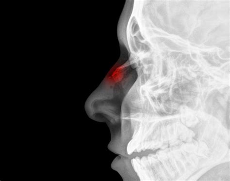 R Duction De Fractures Des Os Propres Du Nez D Viation De La Pyramide