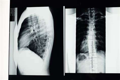 ¿qué Es La Escoliosis Raquis Clínicas Quiroprácticas