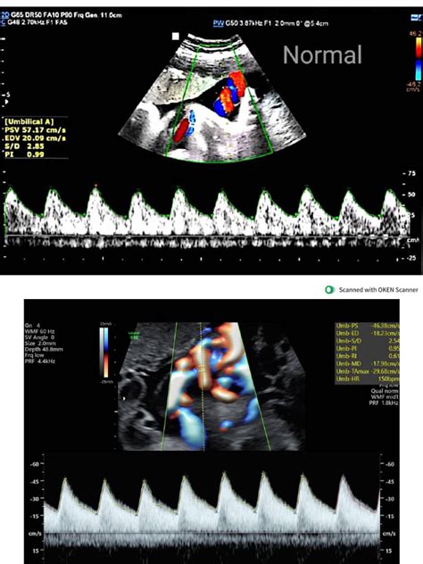 Umbilical Artery Doppler Images | PDF