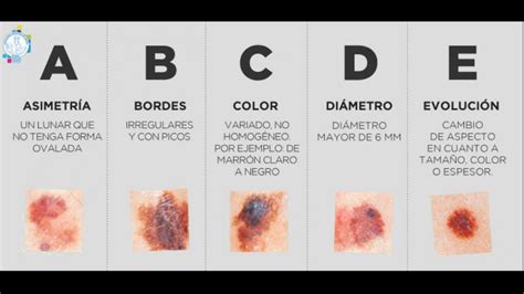 Los dermatólogos elaboran una guía de referencia para tratar el melanoma