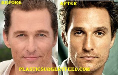 Matthew McConaughey Plastic Surgery - Plastic Surgery Feed