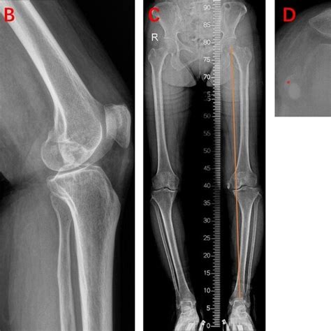 Preoperative X Ray Of The Left Knee A AP View B Lateral View C