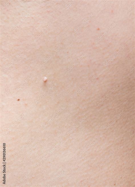 Pedunculated Skin Tag Or Acrochondon Or Soft Fibroma Papilloma On