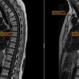 Mm Thick Sagittal T Weighted Images Acquired With A Fast Spin Echo