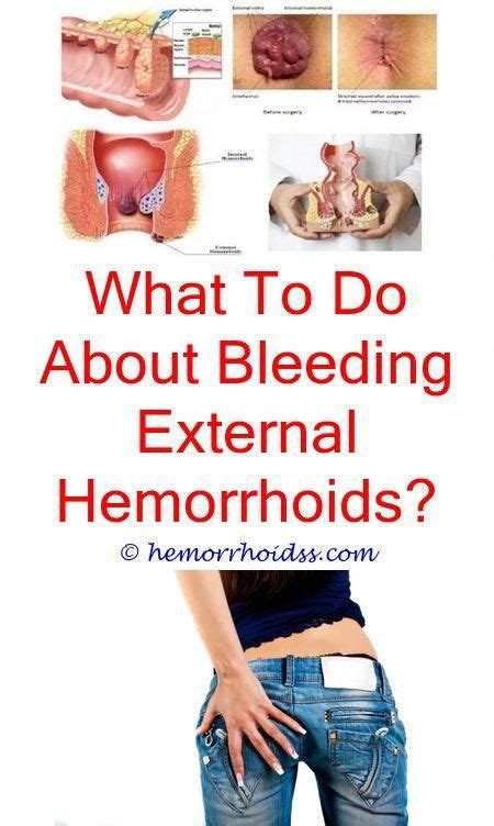 There Are Several Clinically Proven All Natural Hemorrhoid Treatments