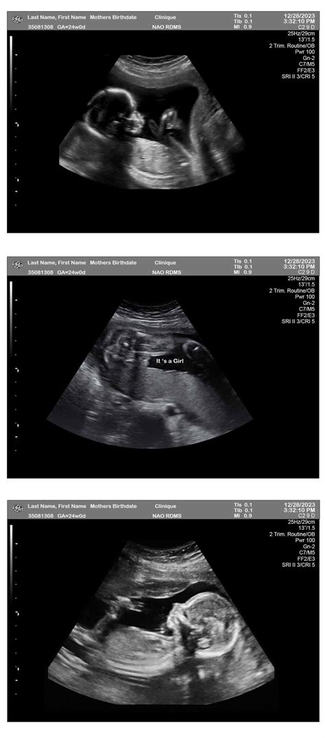 Fetuses Weeks Ultrasound Girl Ultrasounds