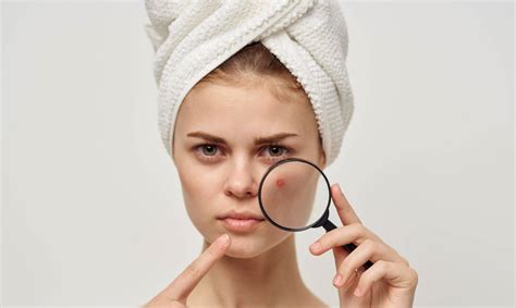 Understanding Acne Causes And Effective Treatments For Clearer Skin