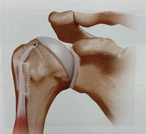 Biceps Tenodesis Shoulder Injuries Dr Christopher Ahmad