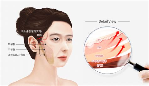 얼굴리프팅 수술·시술 따라 효과 달 이미지 이투데이