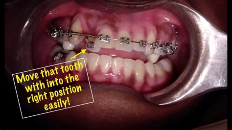 Anterior Crossbite Fix With Braces YouTube