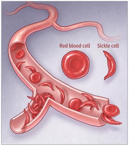 镰状细胞病的新选择 JAMA X MOL