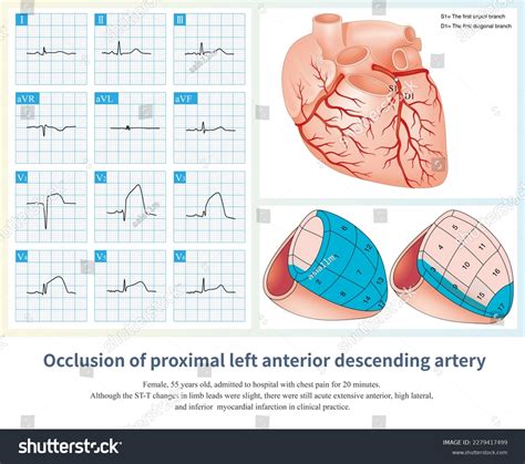 1 Ecg Inferior Anteroseptal Lateral Images, Stock Photos, 3D objects ...