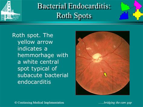 Roth Spots Endocarditis