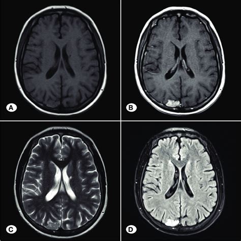 Axial T Weighted A Contrast Enhanced T Weighted B T Weighted