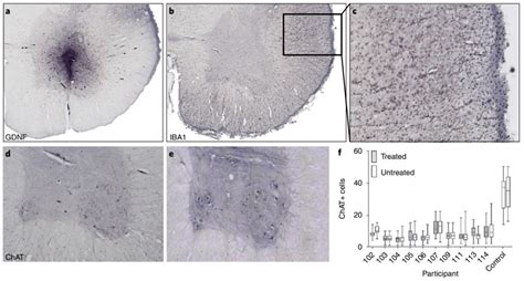 Nature Medicine干细胞 基因疗法治疗渐冻症临床试验结果发布 澎湃号湃客 澎湃新闻 The Paper