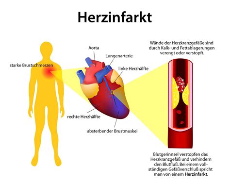 Herzinfarkt Myokardinfarkt Ursachen Symptome Therapie