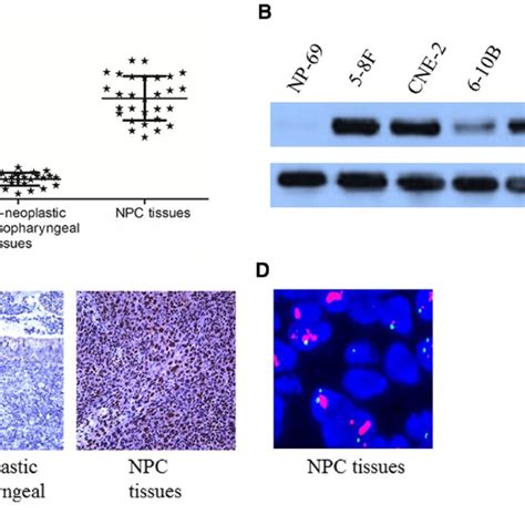 Evi1 Expression Was Elevated In Npc Tissues And Cell Lines A Evi1