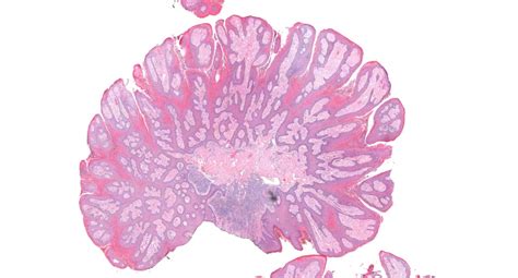 45 Year Old Man With A Polypoid Scrotal Mass Clinical Impression