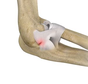 Elbow Ligament Injuries Orthoutah Orthopaedic Surgeons Brigham City