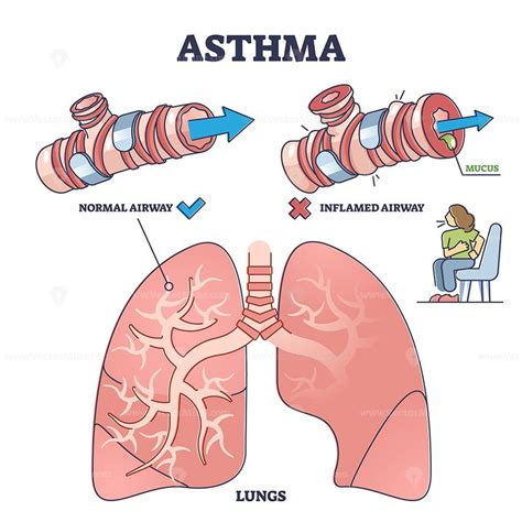 Asthma Health Condition Compared Normal And Inflamed Airway Outline