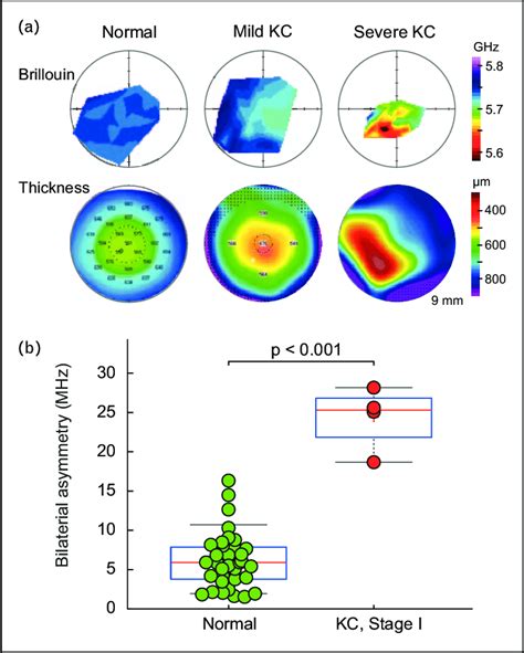 Brillouin Measurement Of Keratoconus Patients A Brillouin Maps And