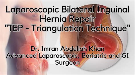 Laparoscopic Bilateral Inguinal Hernia Repair Tep Dr Imran