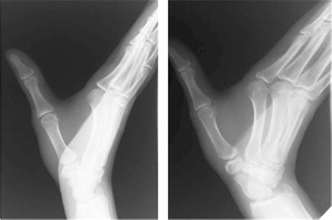 Posteroanterior And Oblique View Radiographs Of The Wrist And Hand