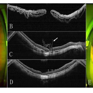 | Preoperative and postoperative SLO and OCT images of the eye of a ...