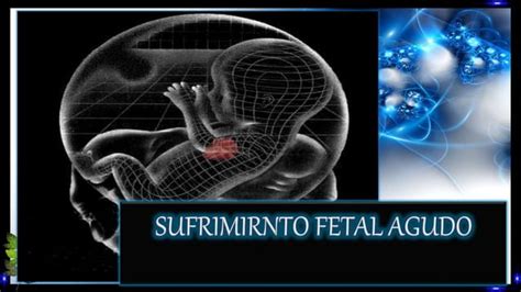 Sufrimiento Fetal Agudo Caso Clinico Ppt