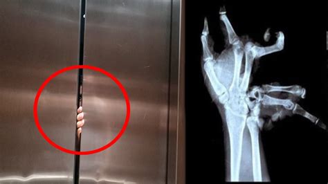 Elevator Crushed His Hand Youtube