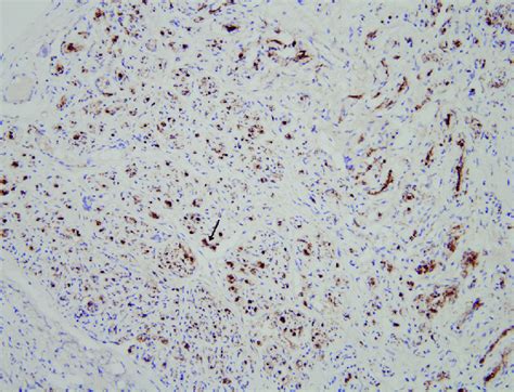 Upon Immunohistochemical Staining Schwann Cells Black Arrow Positive