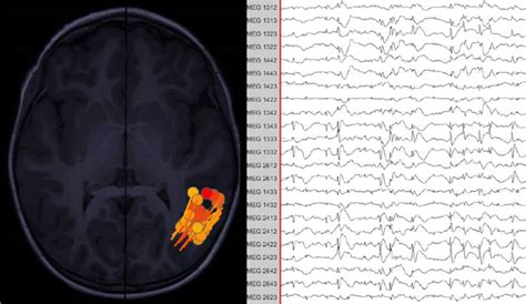 Epiteca Magnetoencefalograf A Meg Neurolog A Madrid Cl Nica