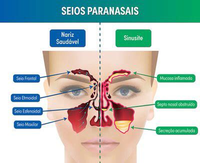 Entenda quais são os sintomas tipos e tratamento para sinusite Pleno