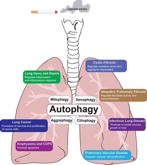 Pulmonary Fibrosis Causes Types Symptoms Diagnosis Stages Treatment Images