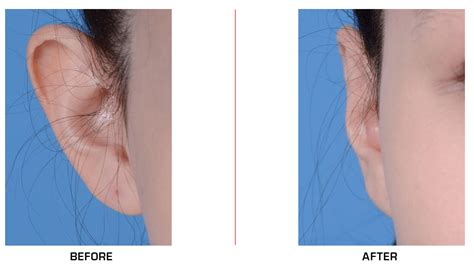 Otoplasty Best Surgeon Ear Surgery Nyc Otoplasty Before After