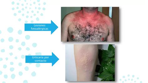 Dermatitis Reaccionales Ppt