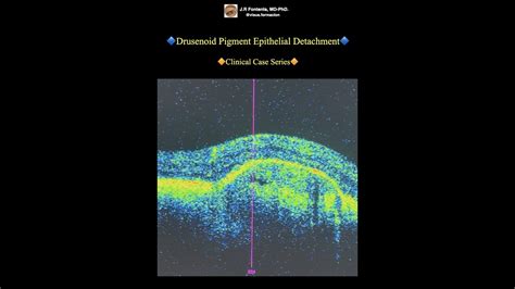 Drusenoid Pigment Epithelial Detachment