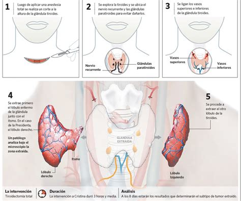 SALUTARIS MEDICAL CENTER Hemitiroidectomia y Tiroidectomía total