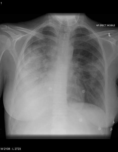 Community-acquired pneumonia chest x ray - wikidoc