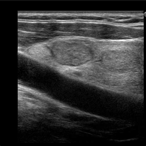 Malignant Thyroid Nodules Ultrasound