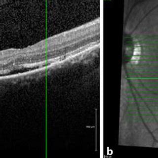 Abb 2 8 Makula OCT Bild Beider Augen Rechts A Und Links B 2 Tage