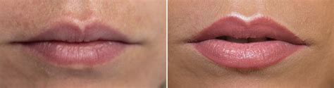 Preenchimento Labial Tipos Preço Antes E Depois