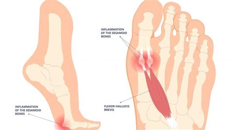 Sesamoiditis Sesamoiditis Treatment And Diagnosis