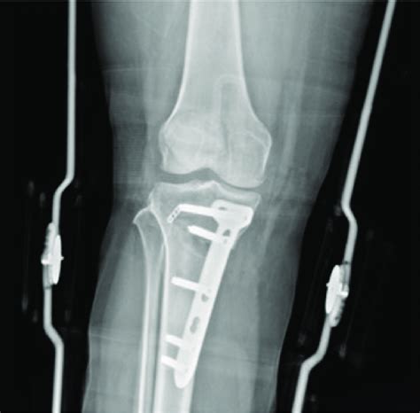 Anteroposterior Radiograph Of The Right Knee Joint In Supine Position Download Scientific