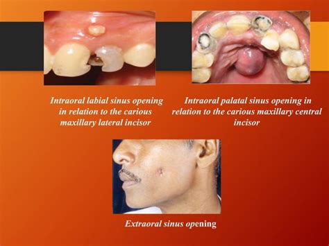 Periapical Diseases And Classification Ppt