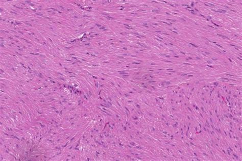 Leiomyoma of the skin | Atlas of Pathology