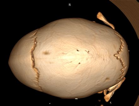 Scaphocephaly Radiology Case Radiopaedia Org