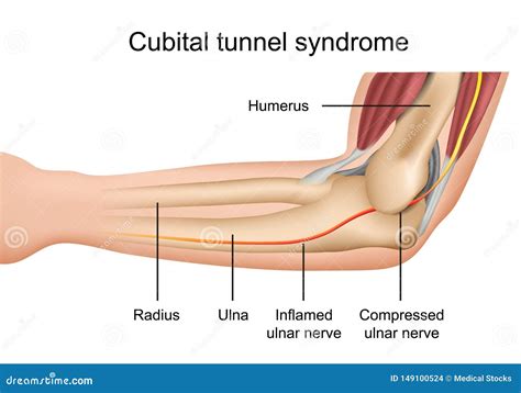 Cubital Tunnel Syndrome Inflamed Ulnar Nerve Medical Vector Illustration On White Background