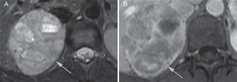 SciELO Brasil Imaging Of The Adrenal Gland Lesions Imaging Of The